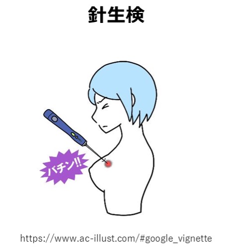 針生検による組織診断