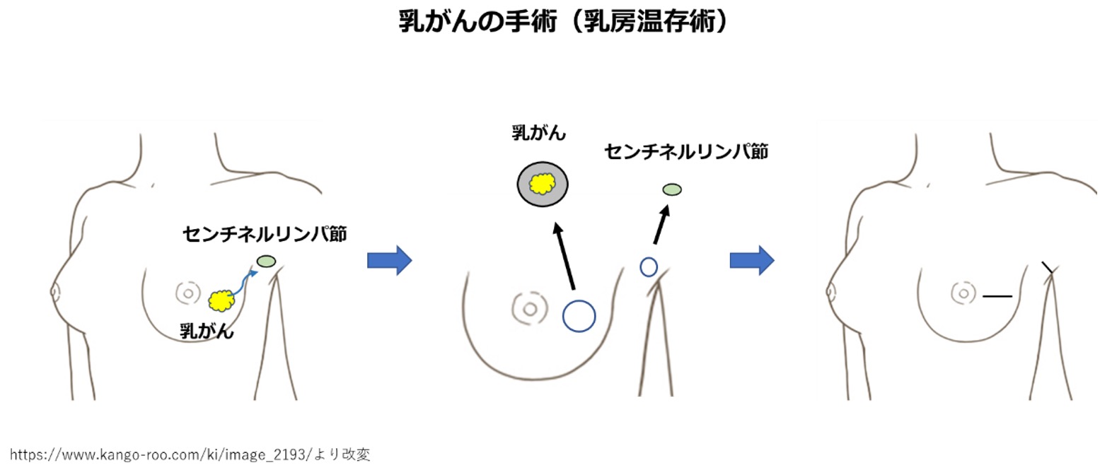 乳房、腋窩リンパ節の手術