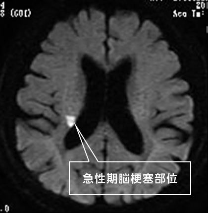 急性期脳梗塞部位