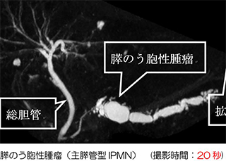 膵のう胞性腫瘤（主膵管型IPMN）(撮影時間：20秒)