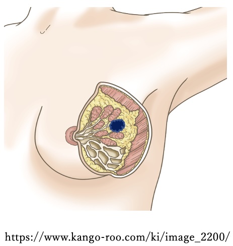 乳がんの検査と治療